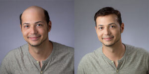 Non Surgical Hair Replacement 300x150